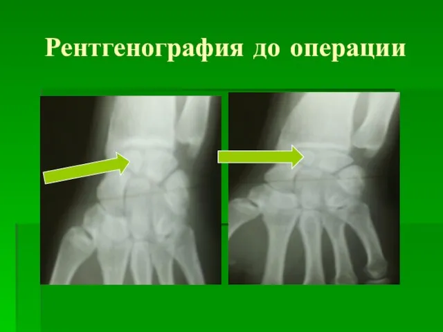 Рентгенография до операции