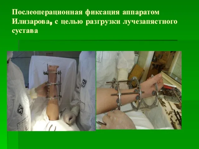 Послеоперационная фиксация аппаратом Илизарова, с целью разгрузки лучезапястного сустава