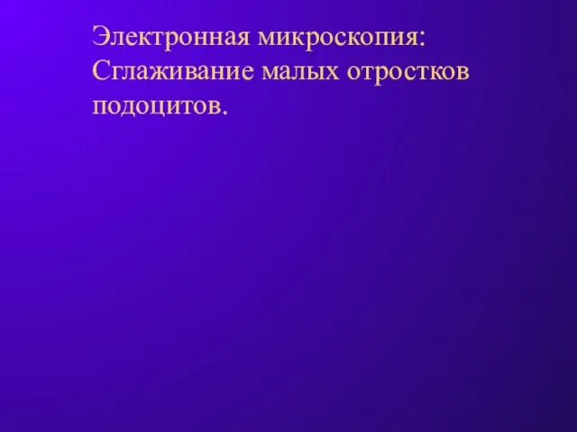 Электронная микроскопия: Сглаживание малых отростков подоцитов.