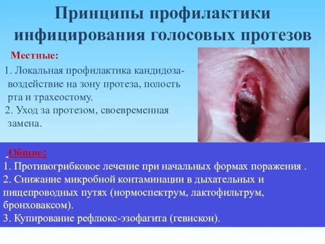 Принципы профилактики инфицирования голосовых протезов Общие: 1. Противогрибковое лечение при начальных формах