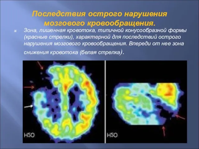 Последствия острого нарушения мозгового кровообращения. Зона, лишенная кровотока, типичной конусообразной формы (красные