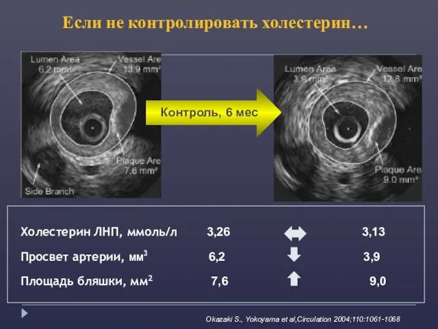 Okazaki S., Yokoyama et al,Circulation 2004;110:1061-1068 Холестерин ЛНП, ммоль/л 3,26 3,13 Просвет