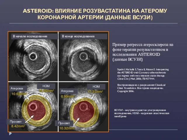 Пример регресса атеросклероза на фоне терапии розувастатином в исследовании ASTEROID (данные ВСУЗИ)