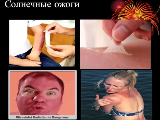 Солнечные ожоги