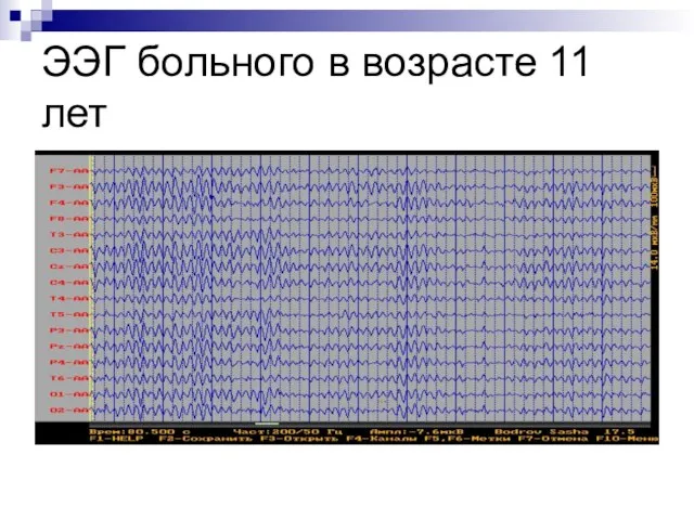 ЭЭГ больного в возрасте 11 лет