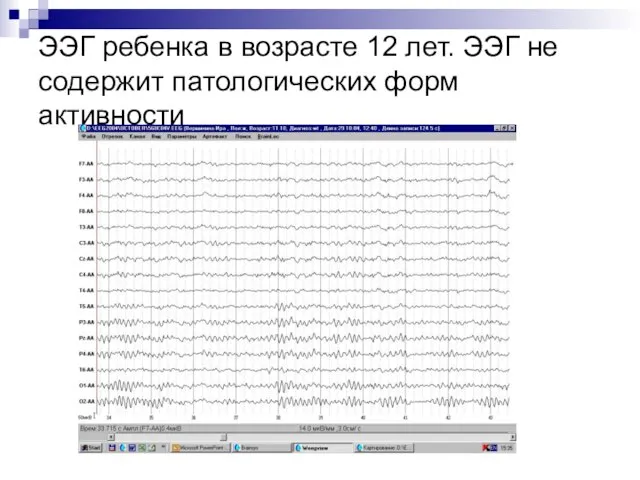 ЭЭГ ребенка в возрасте 12 лет. ЭЭГ не содержит патологических форм активности