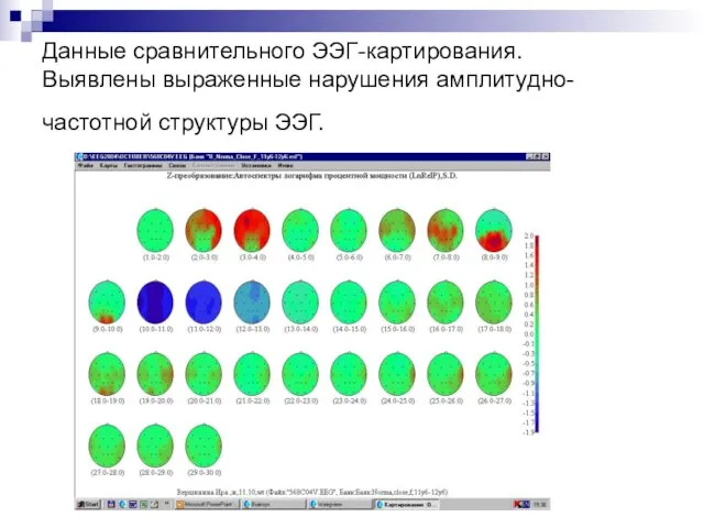 Данные сравнительного ЭЭГ-картирования. Выявлены выраженные нарушения амплитудно-частотной структуры ЭЭГ.