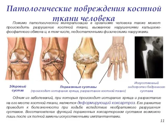 Патологические повреждения костной ткани человека Пораженные суставы (происходит истирание хряща, разрастание костной