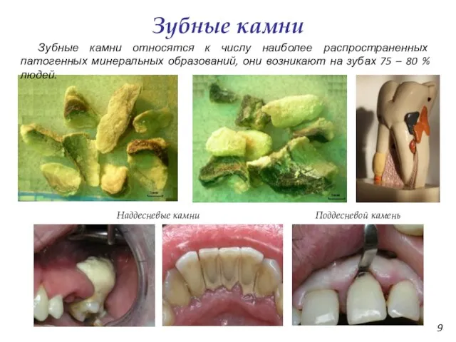 Зубные камни Зубные камни относятся к числу наиболее распространенных патогенных минеральных образований,