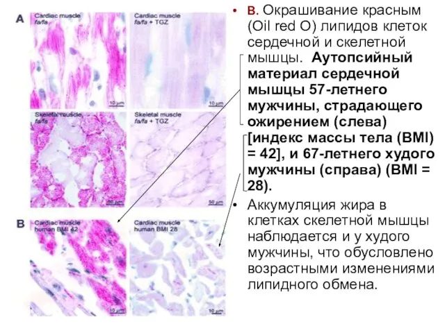 В. Окрашивание красным (Oil red O) липидов клеток сердечной и скелетной мышцы.