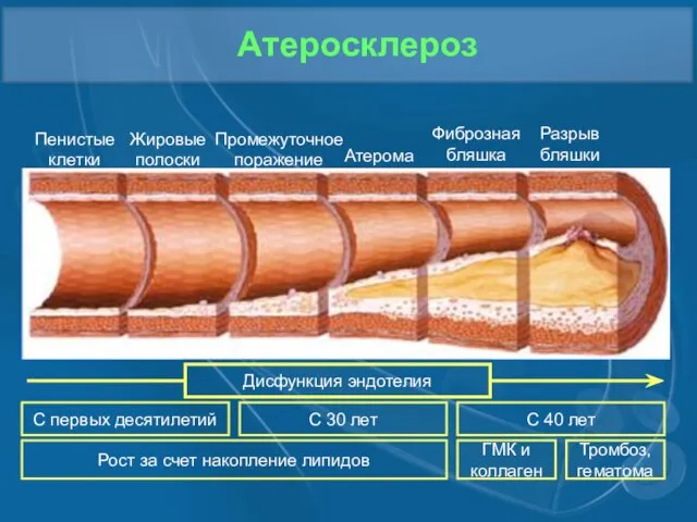 Атеросклероз Пенистые клетки Жировые полоски Промежуточное поражение Атерома Фиброзная бляшка Разрыв бляшки