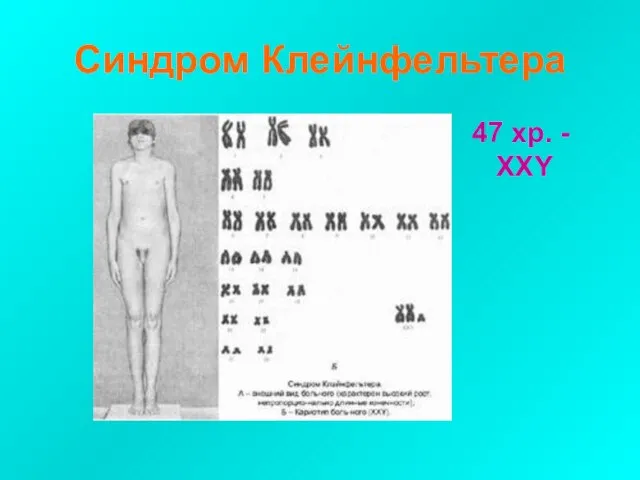 Синдром Клейнфельтера 47 хр. - XXY