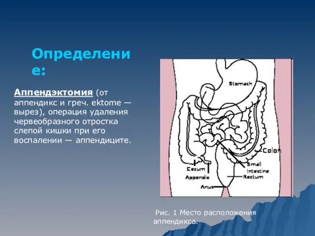 Аппендэктомия (от аппендикс и греч. ektome — вырез), операция удаления червеобразного отростка