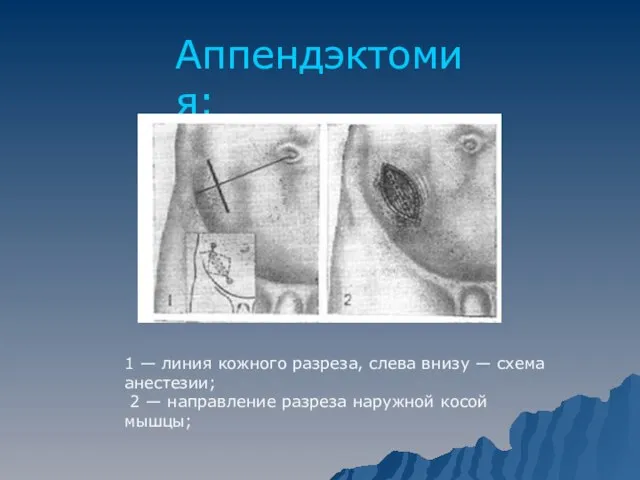 Аппендэктомия: 1 — линия кожного разреза, слева внизу — схема анестезии; 2