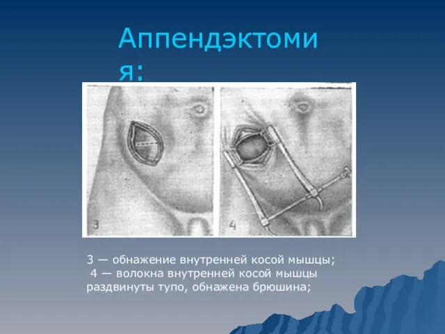 Аппендэктомия: 3 — обнажение внутренней косой мышцы; 4 — волокна внутренней косой