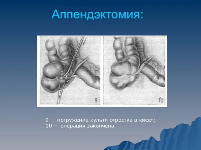 Аппендэктомия: 9 — погружение культи отростка в кисет; 10 — операция закончена.