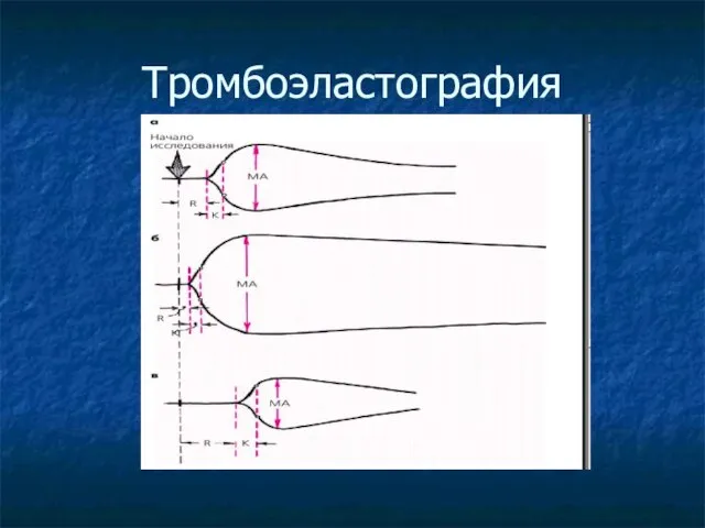 Тромбоэластография