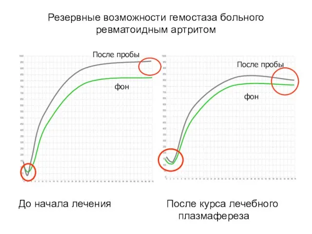 Резервные возможности гемостаза больного ревматоидным артритом До начала лечения После курса лечебного