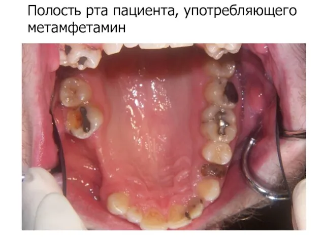 Полость рта пациента, употребляющего метамфетамин