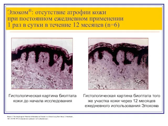 Элоком®: отсутствие атрофии кожи при постоянном ежедневном применении 1 раз в сутки