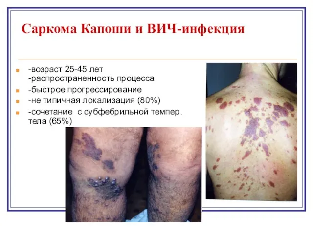 Саркома Капоши и ВИЧ-инфекция -возраст 25-45 лет -распространенность процесса -быстрое прогрессирование -не