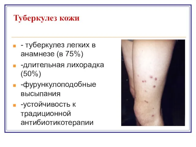 Туберкулез кожи - туберкулез легких в анамнезе (в 75%) -длительная лихорадка (50%)