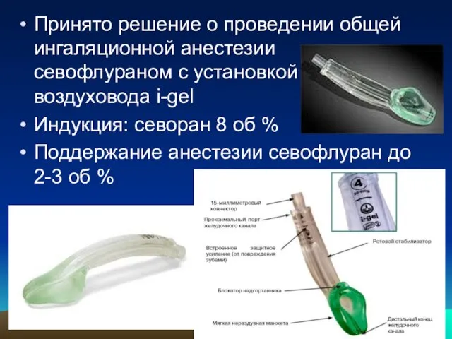 Принято решение о проведении общей ингаляционной анестезии севофлураном с установкой воздуховода i-gel