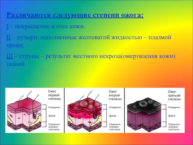 Различаются следующие степени ожога: I – покраснение и отек кожи. II –