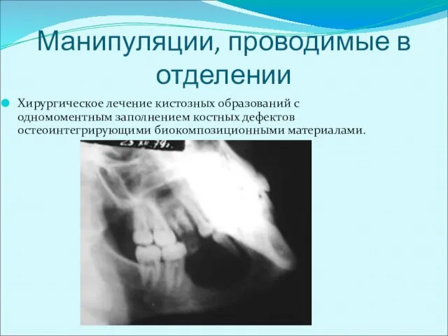 Манипуляции, проводимые в отделении Хирургическое лечение кистозных образований с одномоментным заполнением костных дефектов остеоинтегрирующими биокомпозиционными материалами.