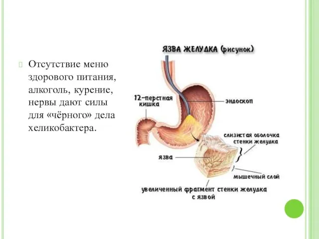 Отсутствие меню здорового питания, алкоголь, курение, нервы дают силы для «чёрного» дела хеликобактера.