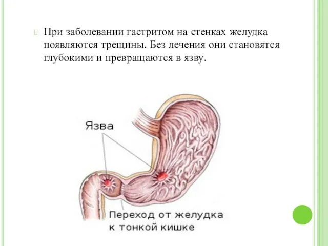 При заболевании гастритом на стенках желудка появляются трещины. Без лечения они становятся