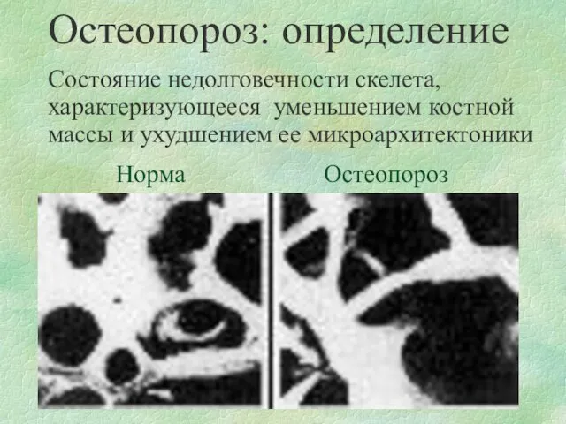 Остеопороз: определение Состояние недолговечности скелета, характеризующееся уменьшением костной массы и ухудшением ее микроархитектоники Норма Остеопороз