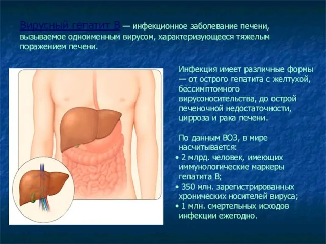 Вирусный гепатит В — инфекционное заболевание печени, вызываемое одноименным вирусом, характеризующееся тяжелым