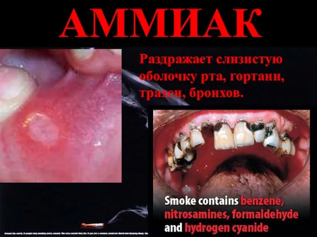 АММИАК Раздражает слизистую оболочку рта, гортани, трахеи, бронхов.