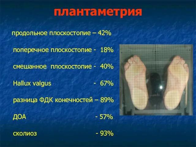 плантаметрия продольное плоскостопие – 42% поперечное плоскостопие - 18% смешанное плоскостопие -