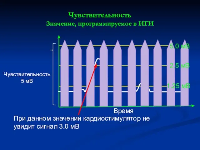 При данном значении кардиостимулятор не увидит сигнал 3.0 мВ Чувствительность Значение, программируемое в ИГИ