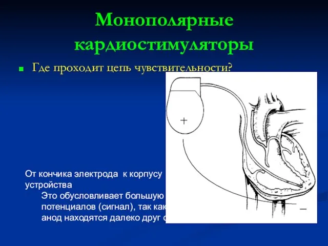 Монополярные кардиостимуляторы Где проходит цепь чувствительности? _ катод анод От кончика электрода