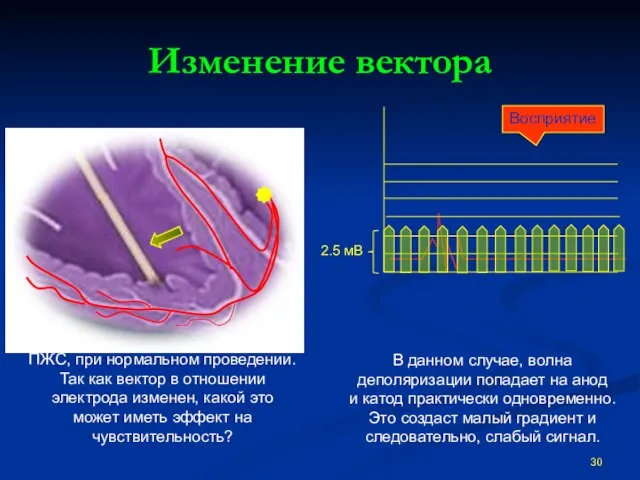 Изменение вектора Восприятие ПЖС, при нормальном проведении. Так как вектор в отношении