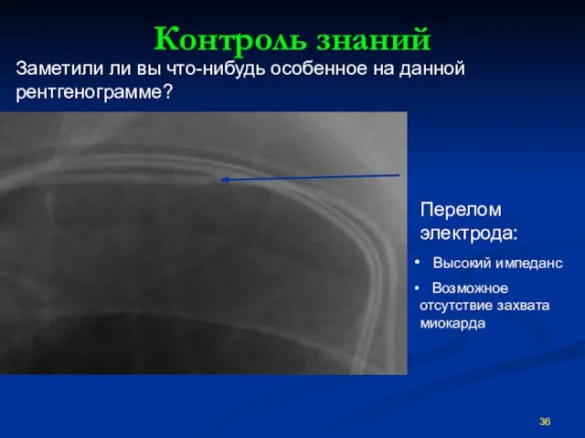 Контроль знаний Перелом электрода: Высокий импеданс Возможное отсутствие захвата миокарда Заметили ли