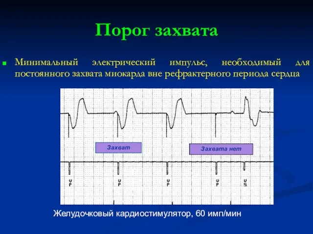 Порог захвата Минимальный электрический импульс, необходимый для постоянного захвата миокарда вне рефрактерного периода сердца