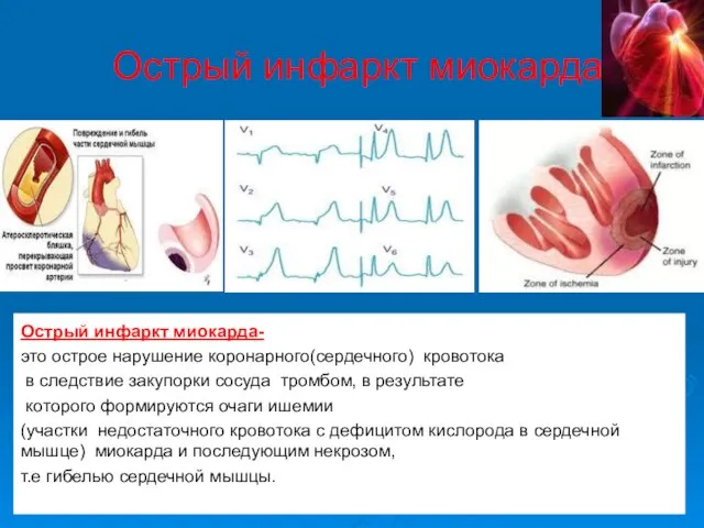 Острый инфаркт миокарда Острый инфаркт миокарда- это острое нарушение коронарного(сердечного) кровотока в