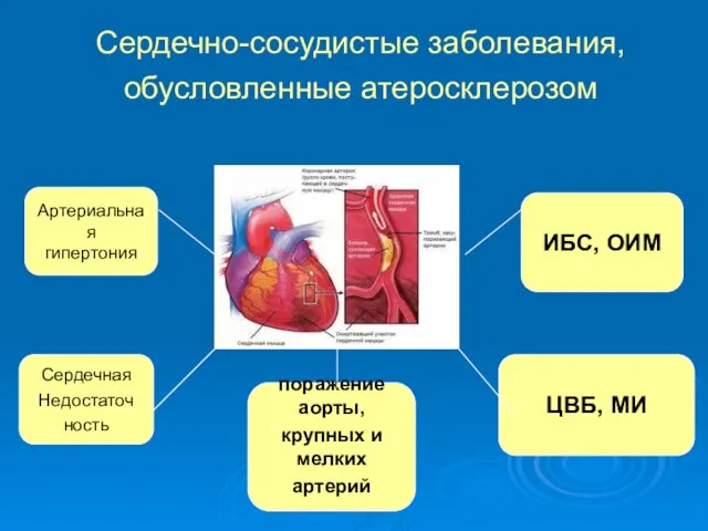 Сердечно-сосудистые заболевания, обусловленные атеросклерозом Артериальная гипертония Сердечная Недостаточ ность поражение аорты, крупных