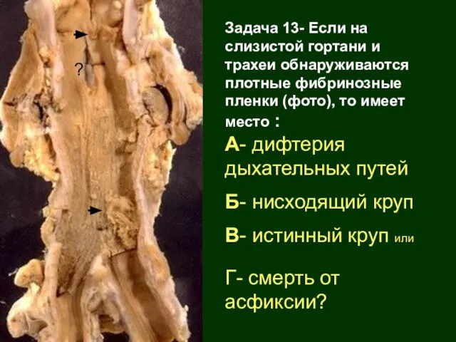 Задача 13- Если на слизистой гортани и трахеи обнаруживаются плотные фибринозные пленки