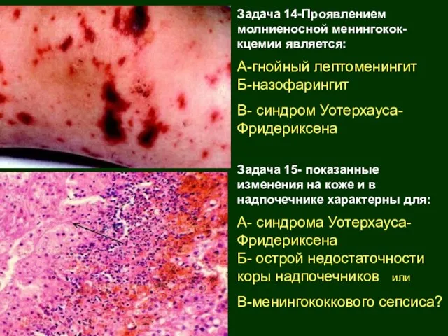 Задача 14-Проявлением молниеносной менингокок-кцемии является: А-гнойный лептоменингит Б-назофарингит В- синдром Уотерхауса-Фридериксена Задача