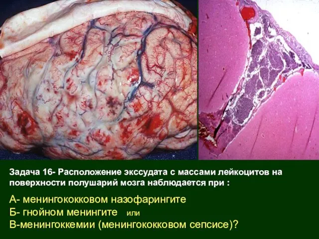 Задача 16- Расположение экссудата с массами лейкоцитов на поверхности полушарий мозга наблюдается