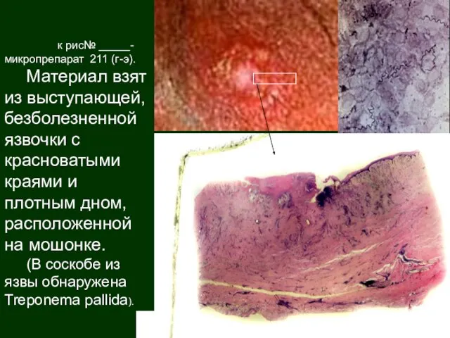 к рис№ _____-микропрепарат 211 (г-э). Материал взят из выступающей, безболезненной язвочки с