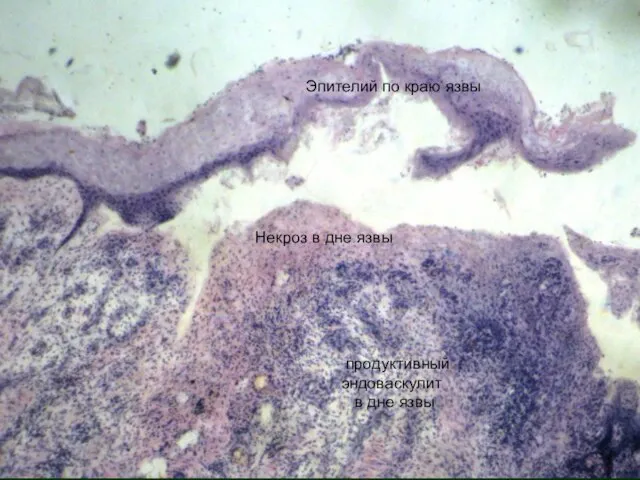 Эпителий по краю язвы Некроз в дне язвы продуктивный эндоваскулит в дне язвы