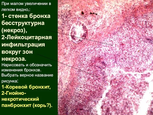 При малом увеличении в легком видно,: 1- стенка бронха бесструктурна (некроз), 2-Лейкоцитарная