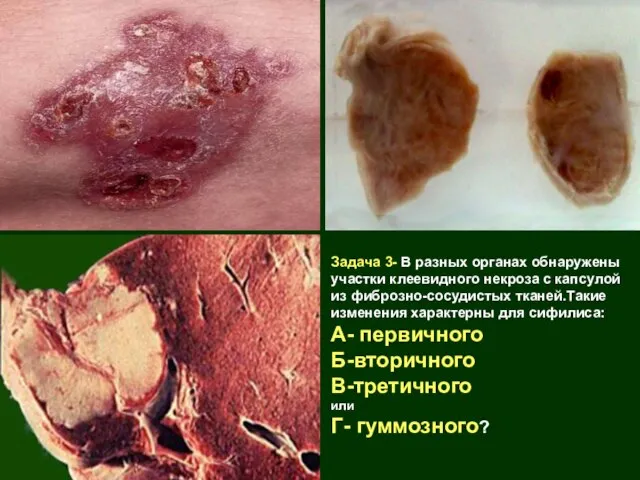 Задача 3- В разных органах обнаружены участки клеевидного некроза с капсулой из