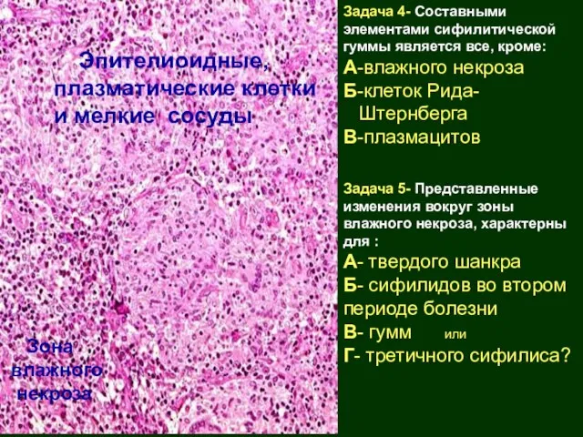 Задача 4- Составными элементами сифилитической гуммы является все, кроме: А-влажного некроза Б-клеток